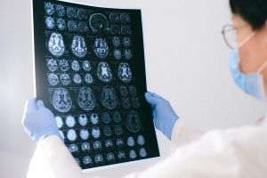 Cercetătorii dezvoltă o terapie imunologică personalizată împotriva uneia dintre cele mai agresive tumori cerebrale