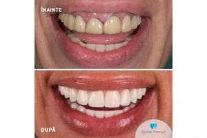 Implantologia dentară, în atenţia diasporei în 2026 - exemplul Dental Premier din Bucureşti