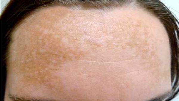 Cum se tratează melasma?