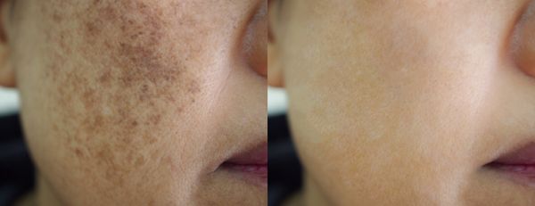 Cum se tratează melasma?